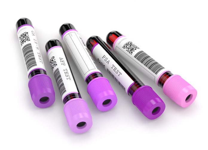 3d render of blood samples with tumor markers test tumore testa collo biomarker